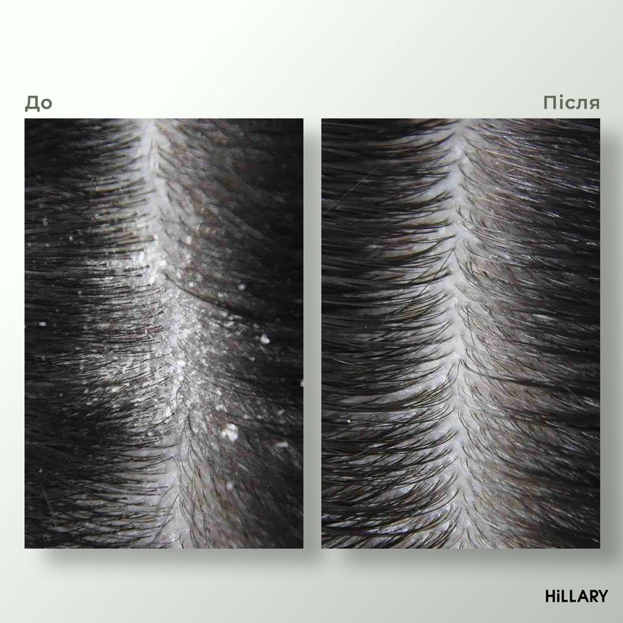 Enzyme peeling for the scalp + Complex against hair loss Hillary Serenoa & PP Hair Loss Control